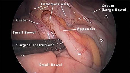 Endometriosis of the Appendix