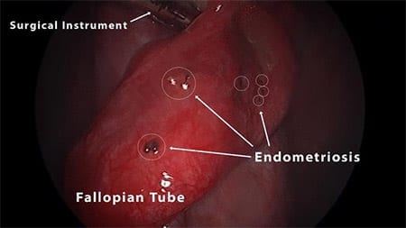 Endometriosis of the Right Fallopian Tube