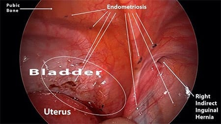 Bladder endometriosis and right indirect inguinal hernia