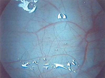 Clear Bladder Endometriosis on GnRH Treatment (Synarel)