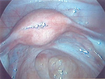 Clear and White Endometriosis on GnRH Treatment (Synarel)