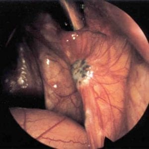 endometriosis