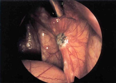 Endometriosis