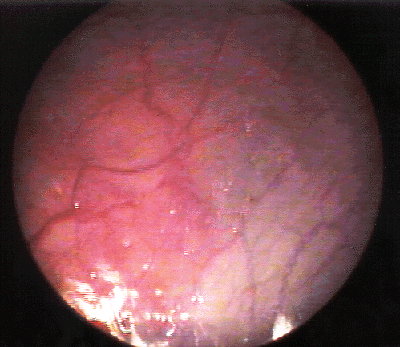 Clear Endometriosis #3