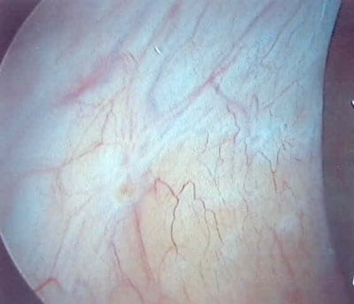 Left Uterosacral Endometriosis on GnRH Treatment (Synarel)