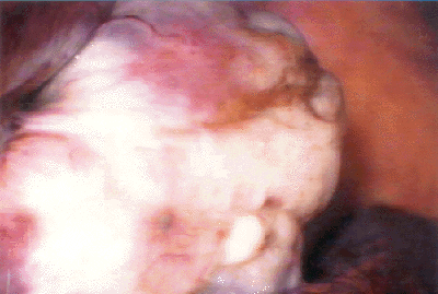 Ovarian Endometriosis