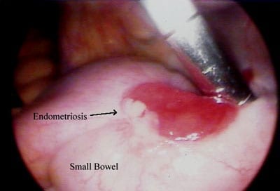 Small Bowel Endometriosis