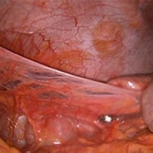 Adhesions