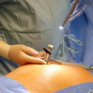 minimally invasive endometriosis surgery