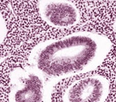 Adenomyosis